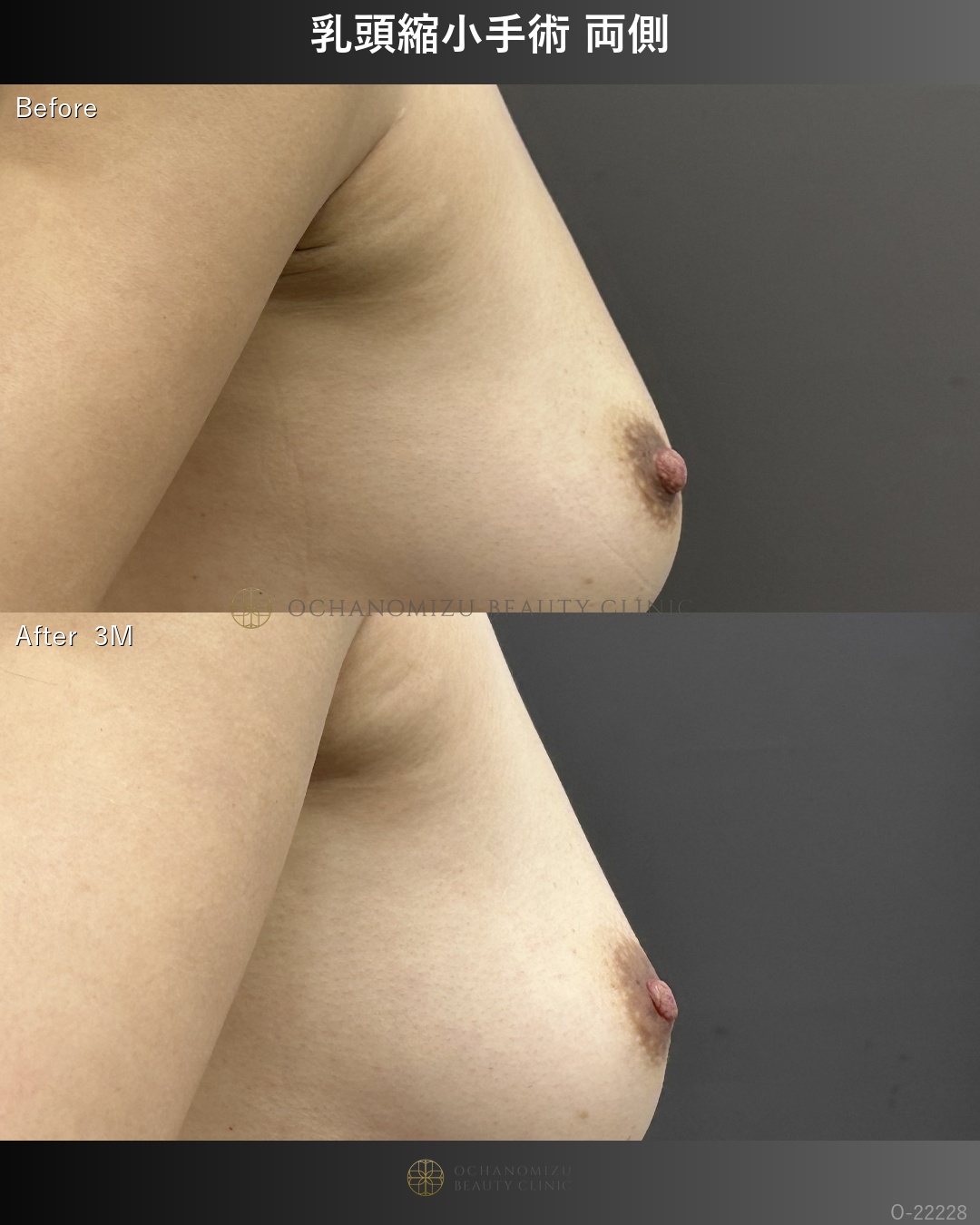 乳頭縮小