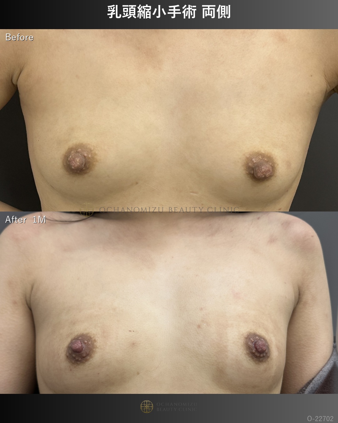 乳頭縮小