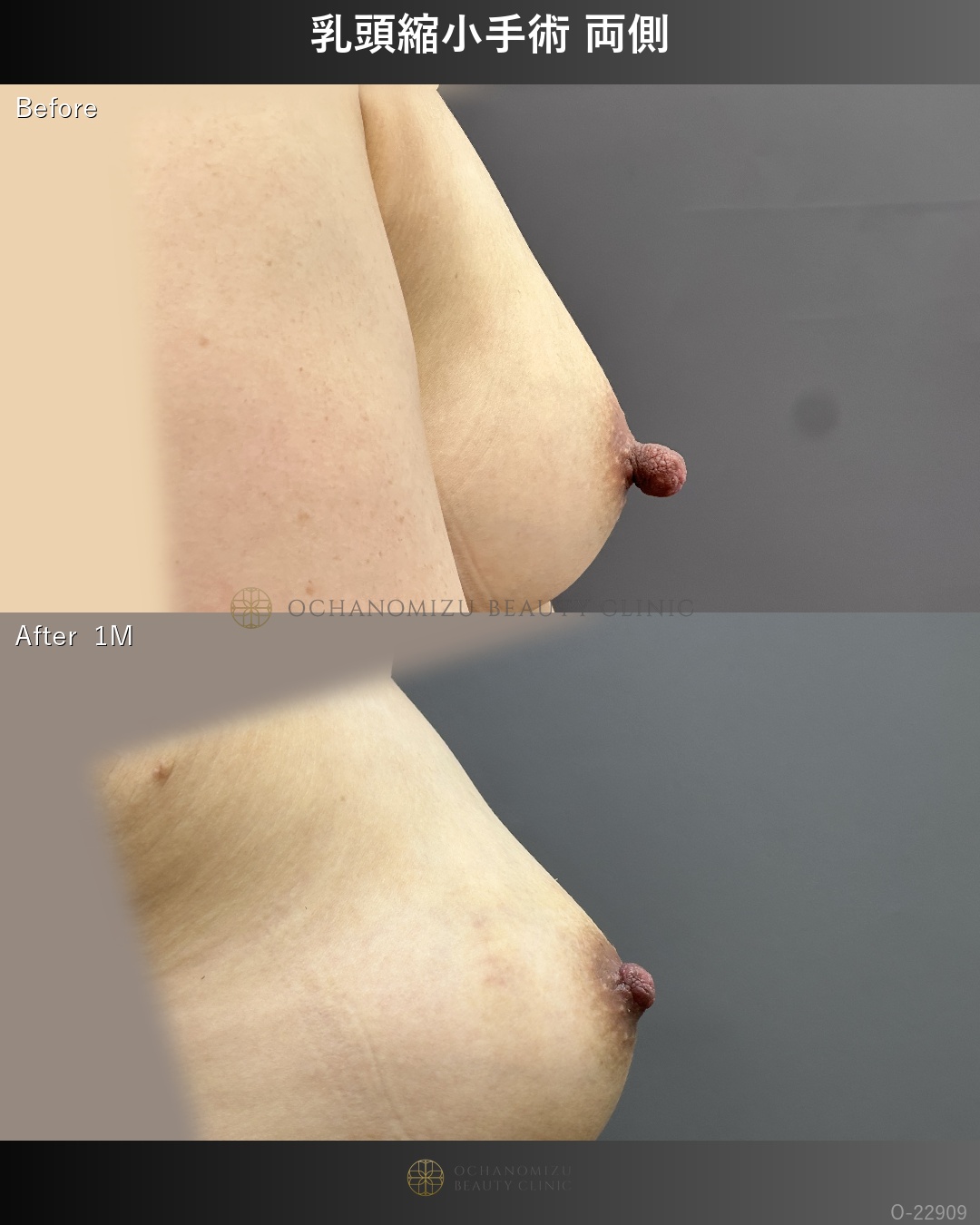 乳頭縮小