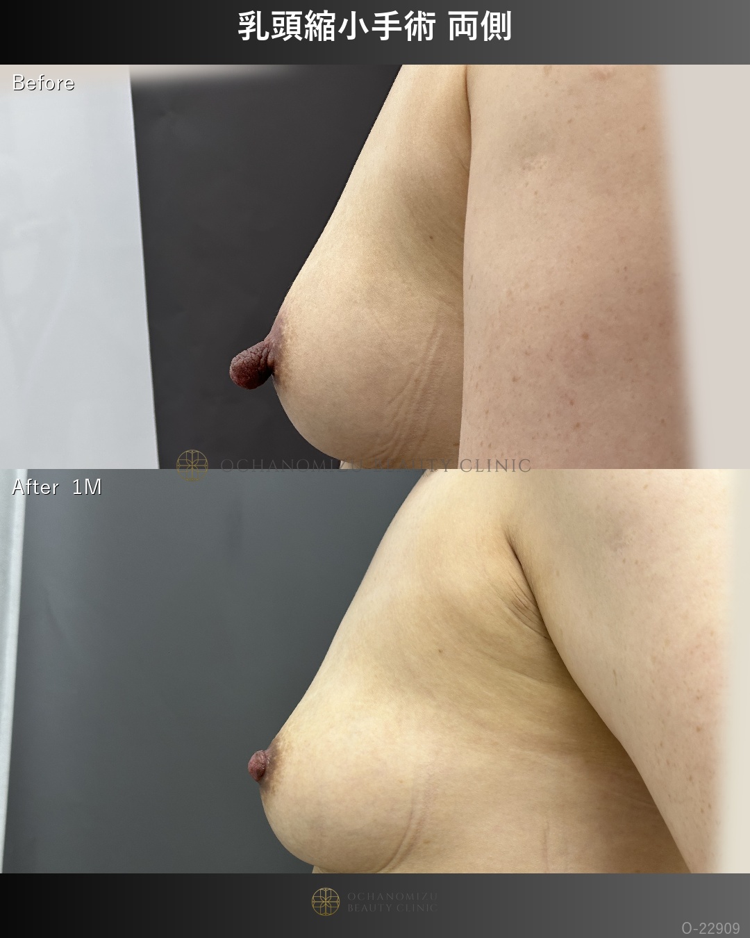 乳頭縮小