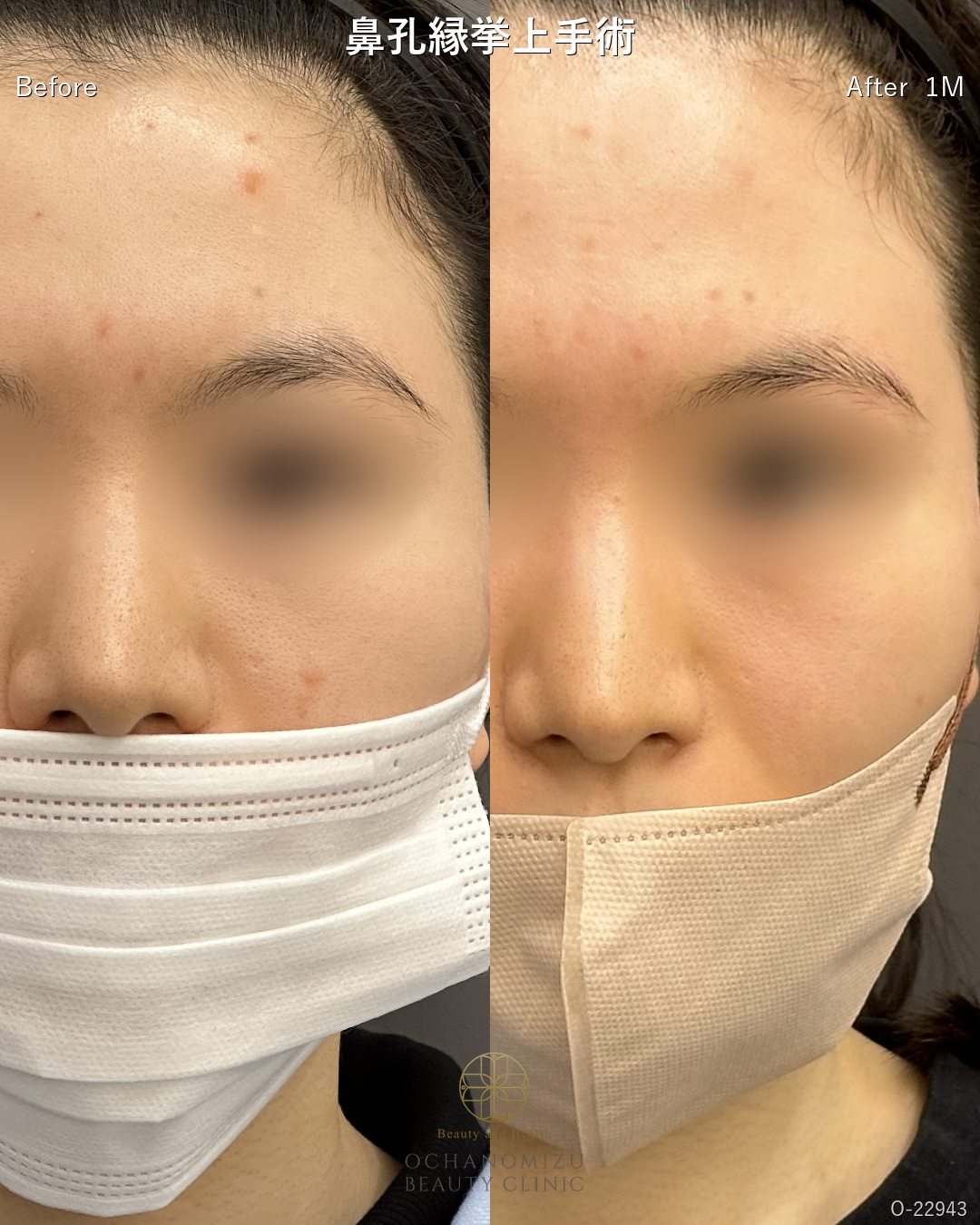 鼻孔縁挙上