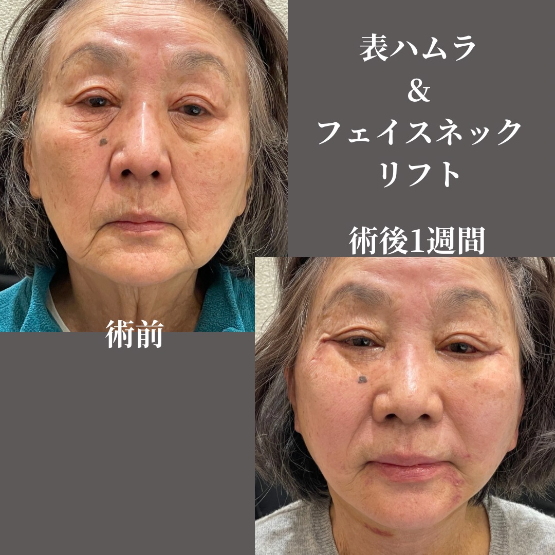 表ハムラ＆ネックリフト
