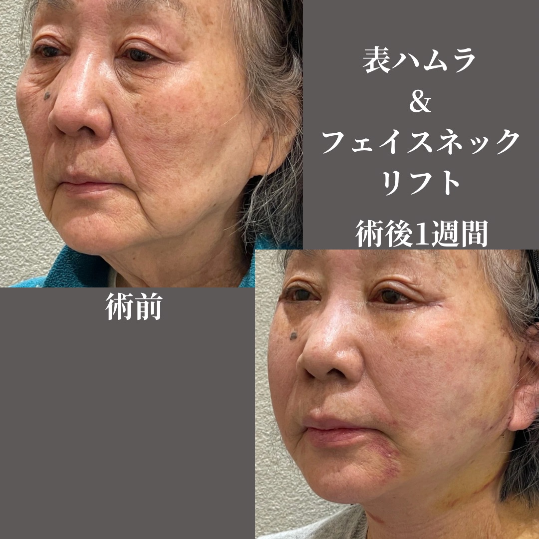表ハムラ＆ネックリフト
