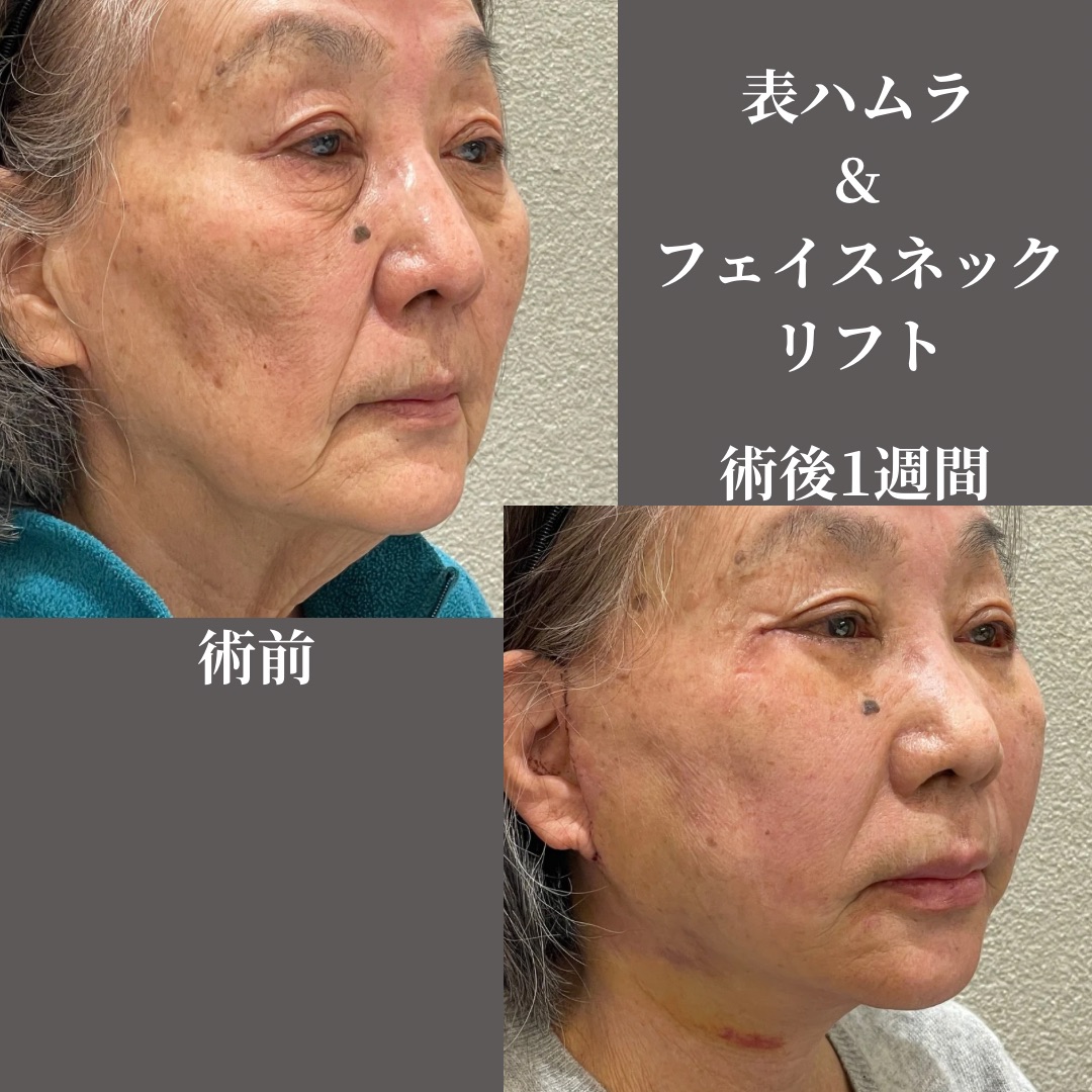 表ハムラ＆ネックリフト