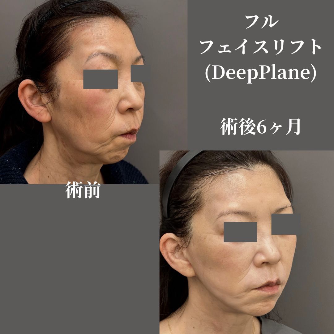 フルフェイスリフト