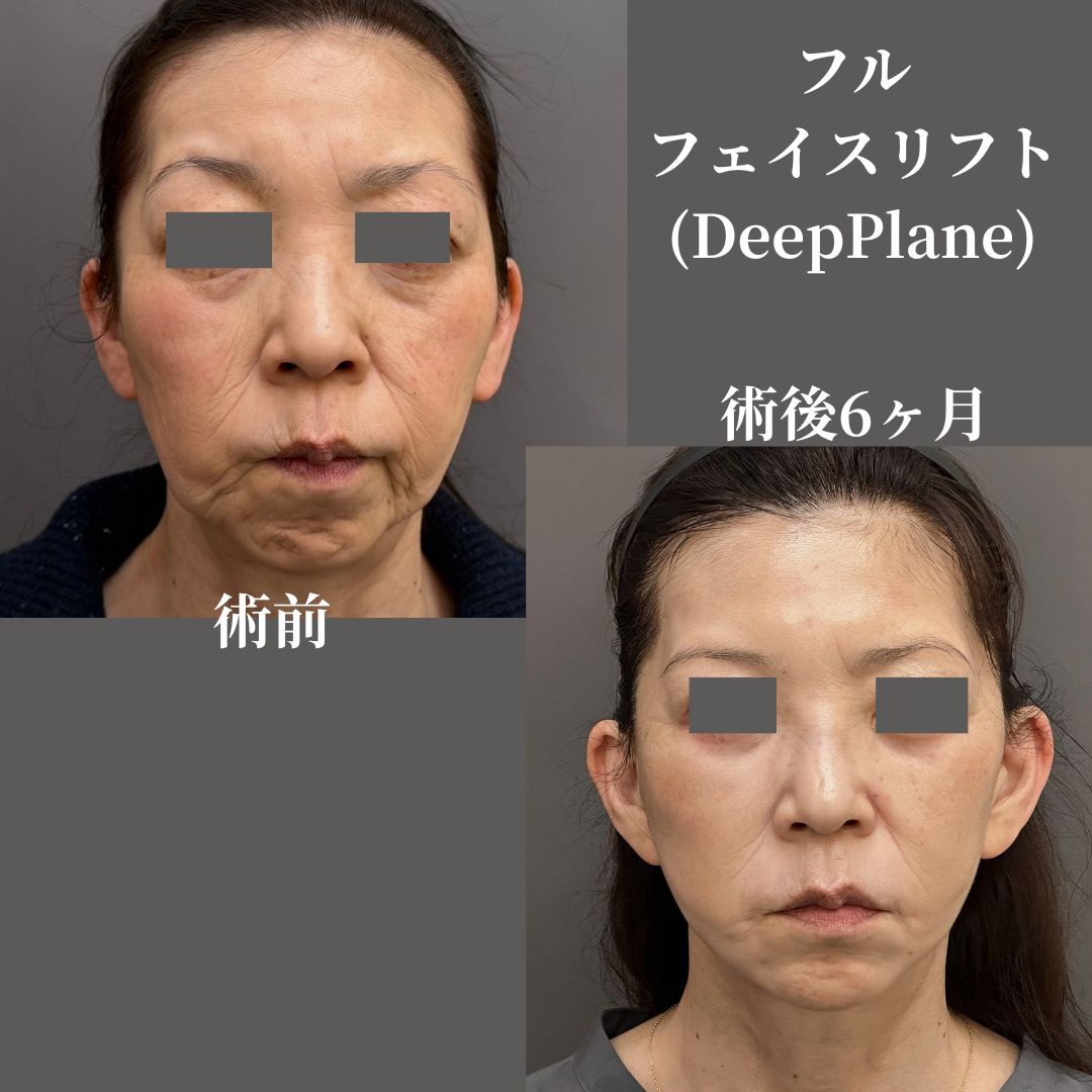 フルフェイスリフト