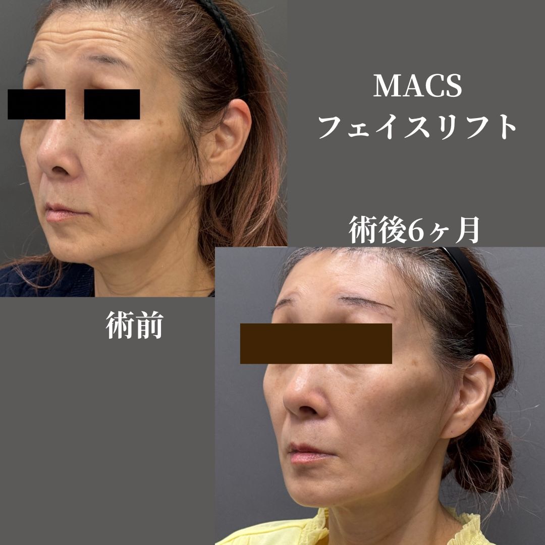 拡大MACSフェイスリフト