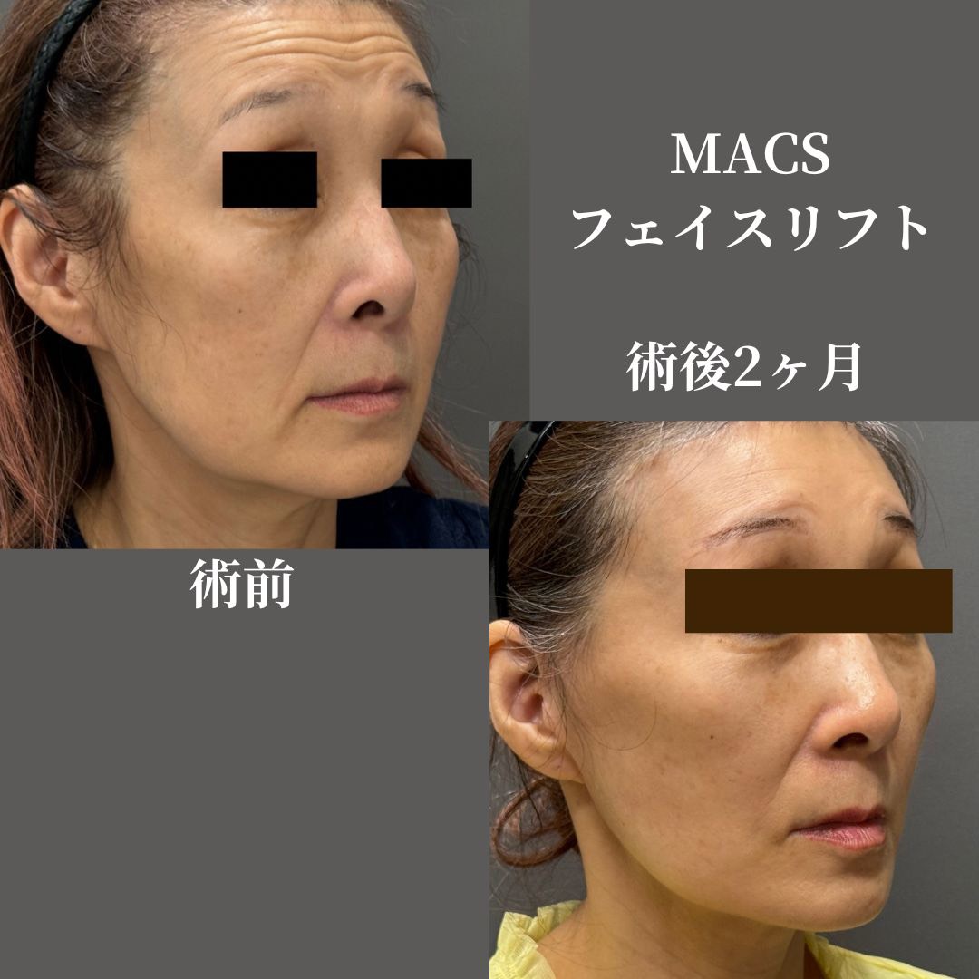拡大MACSフェイスリフト