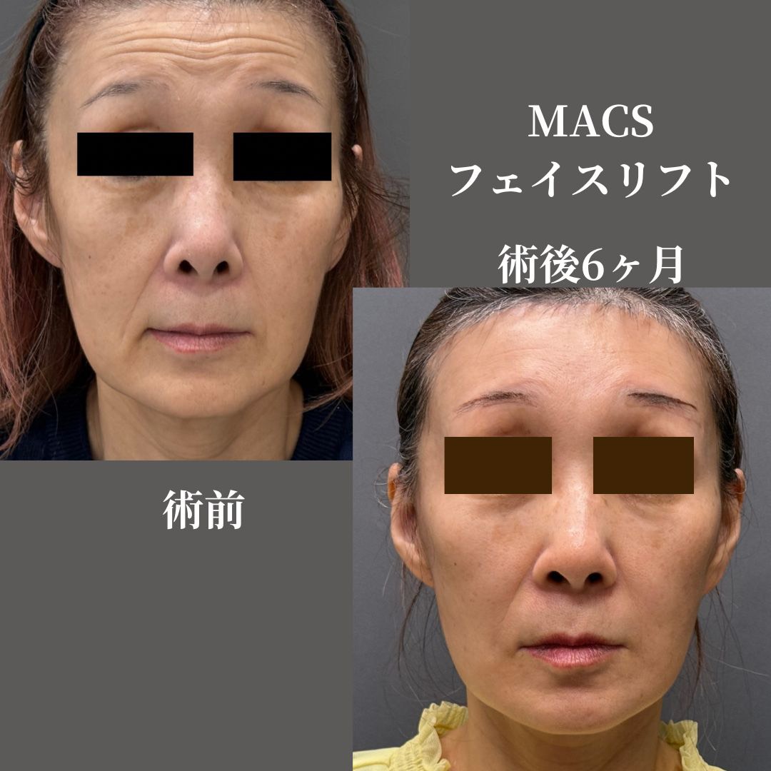 拡大MACSフェイスリフト