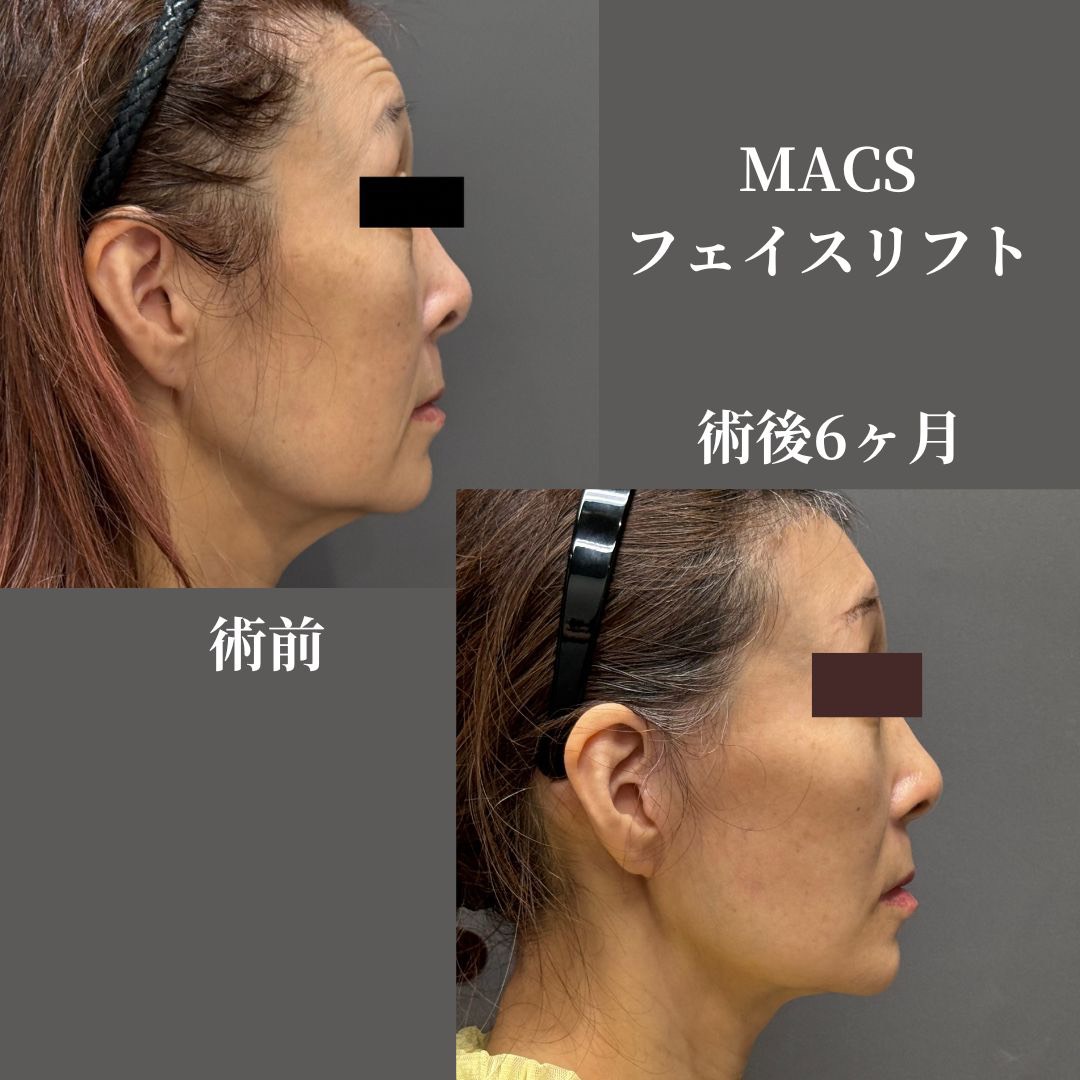 拡大MACSフェイスリフト