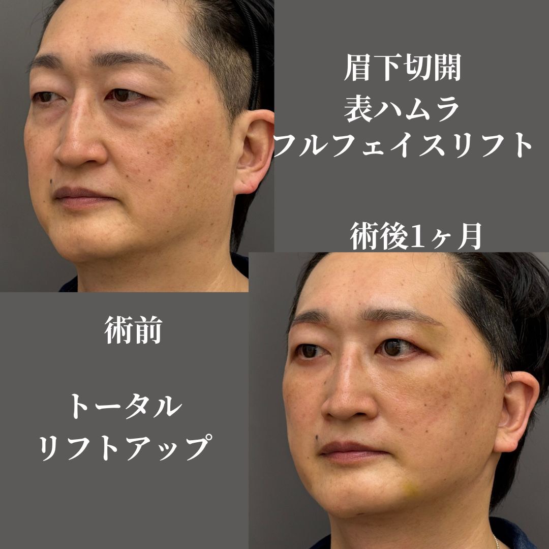 眉下切開+表ハムラ+フルフェイスリフト