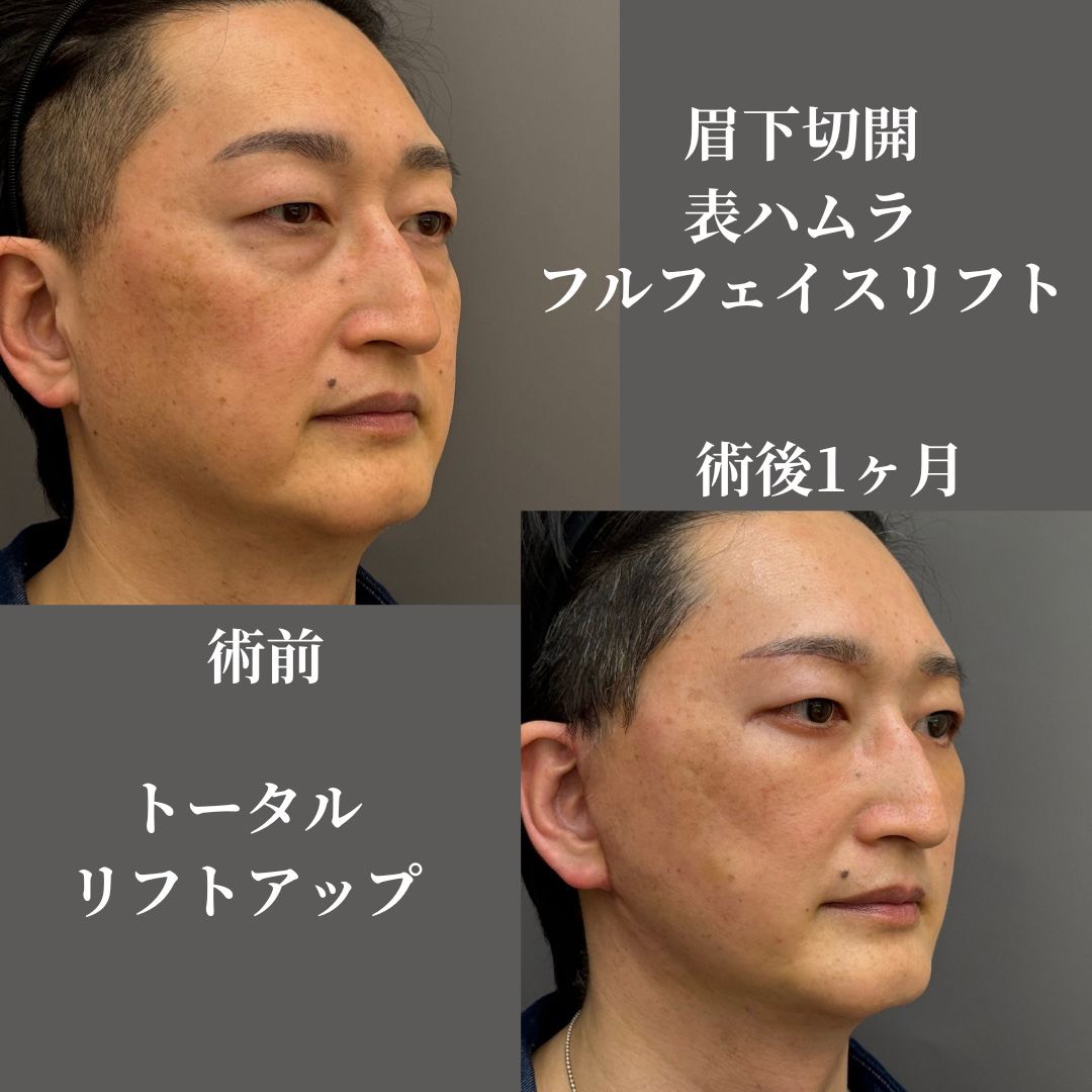 眉下切開+表ハムラ+フルフェイスリフト