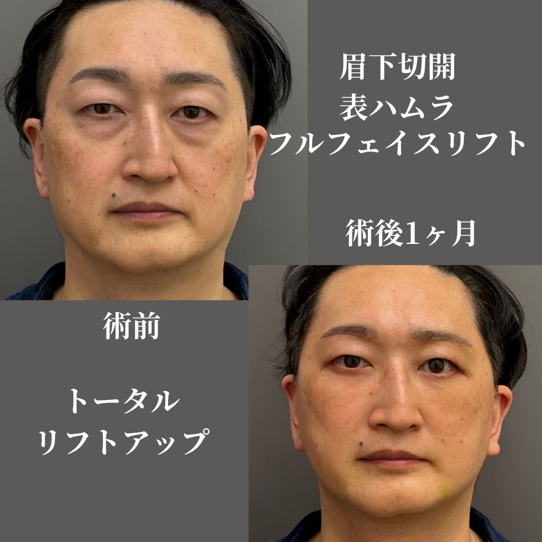 眉下切開+表ハムラ+フルフェイスリフト