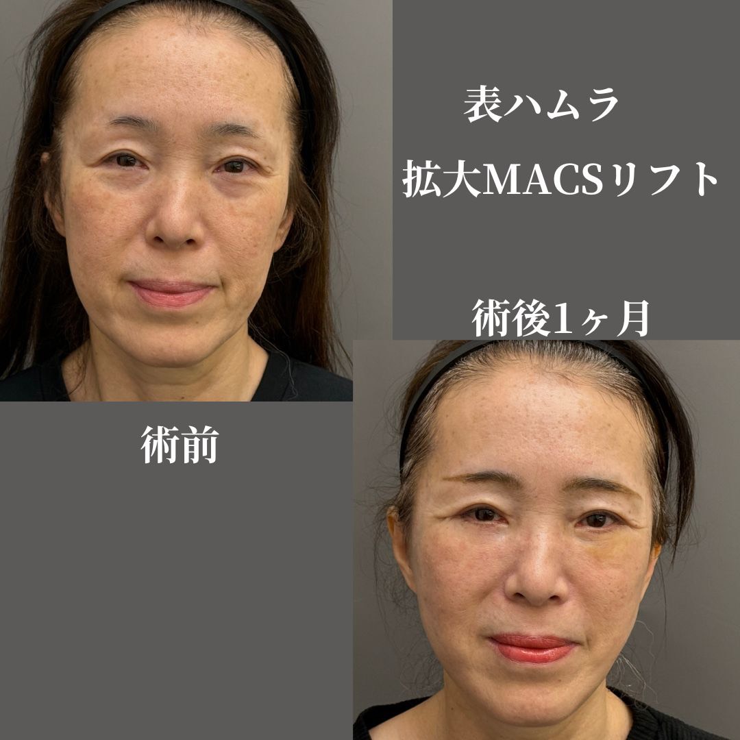 表ハムラ+拡大MACSフェイスリフト
