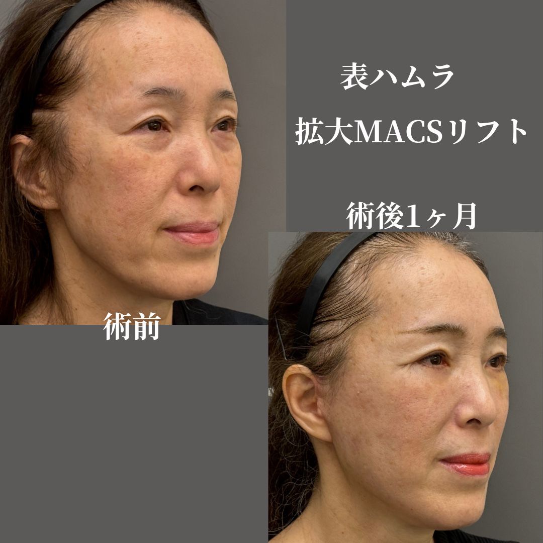 表ハムラ+拡大MACSフェイスリフト