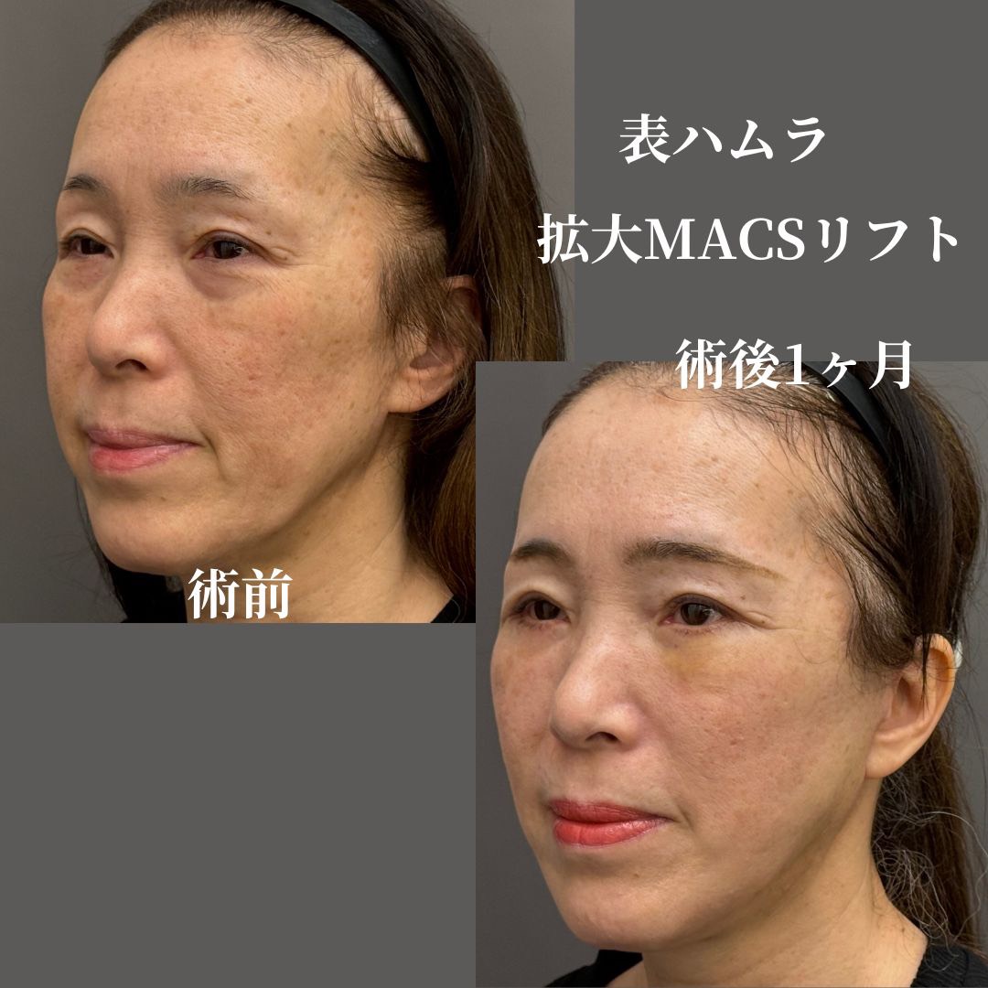 表ハムラ+拡大MACSフェイスリフト