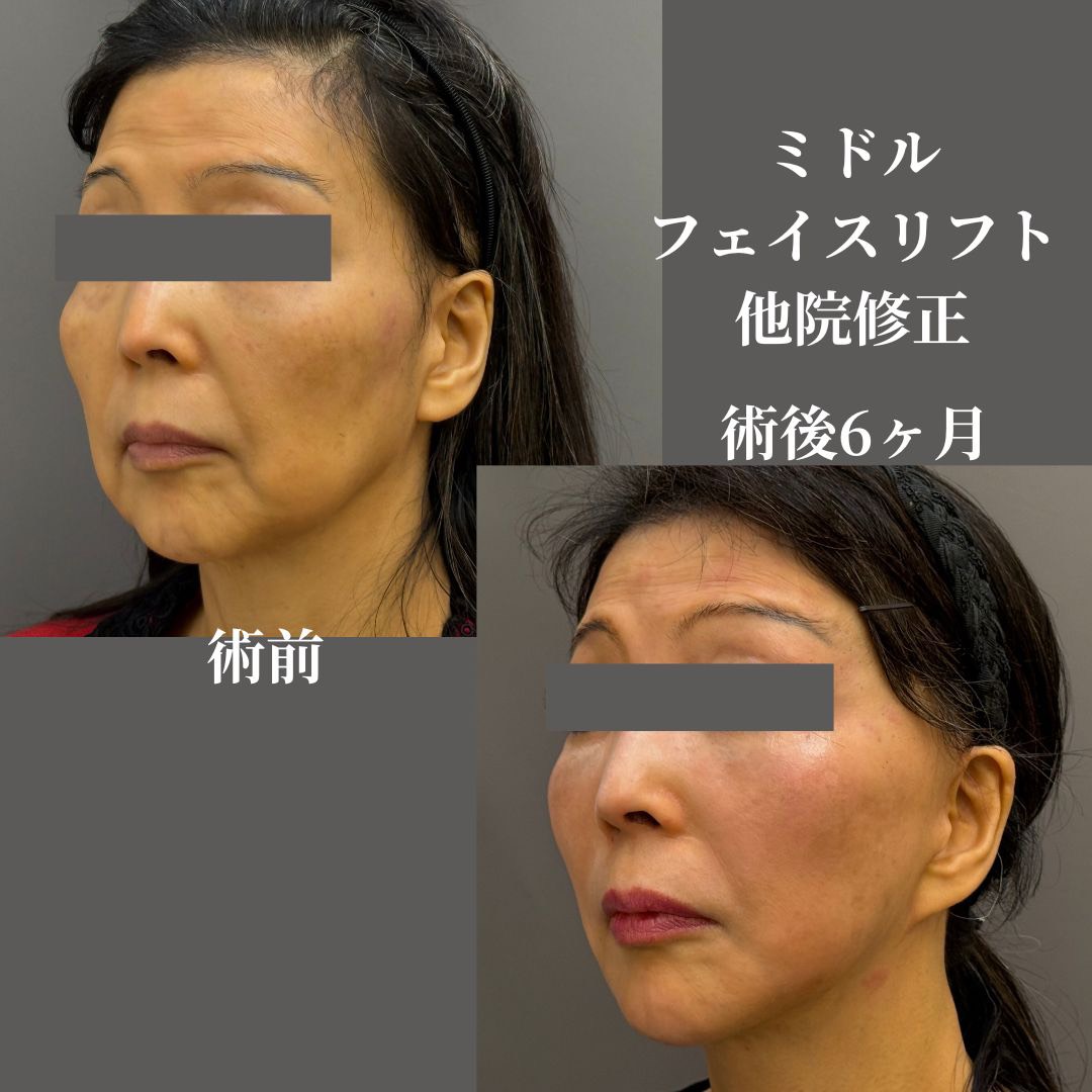 ミドルフェイスリフト