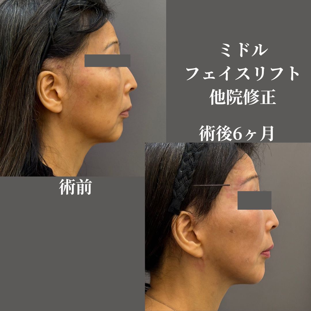 ミドルフェイスリフト