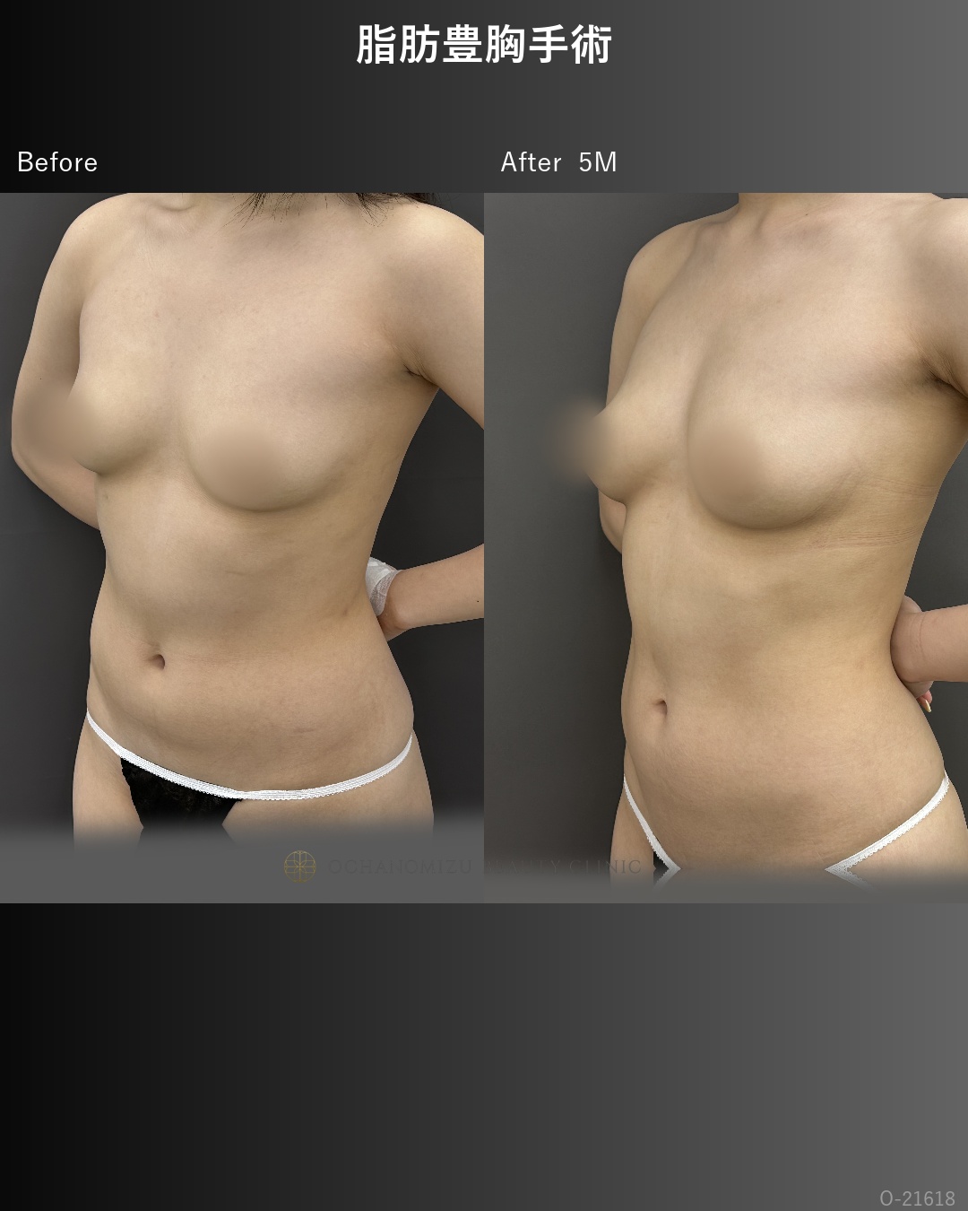 脂肪豊胸