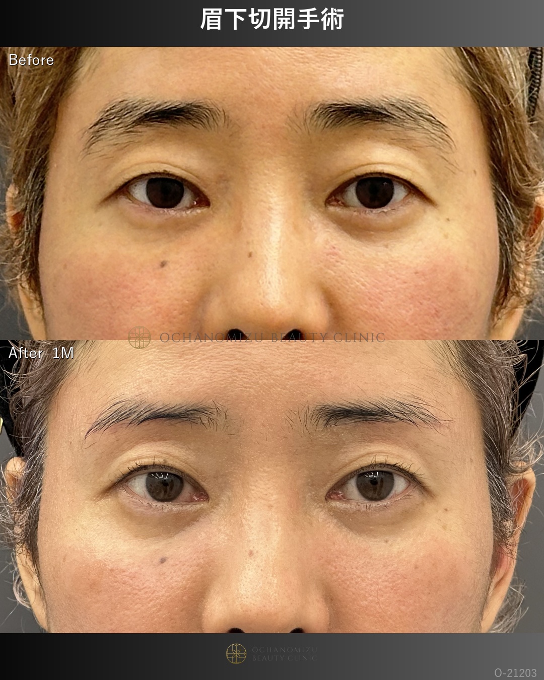 眉下切開