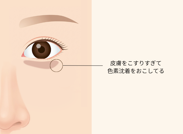 茶クマのしくみ｜皮膚をこすりすぎて目の下に色素沈着が起きている状態を示した図