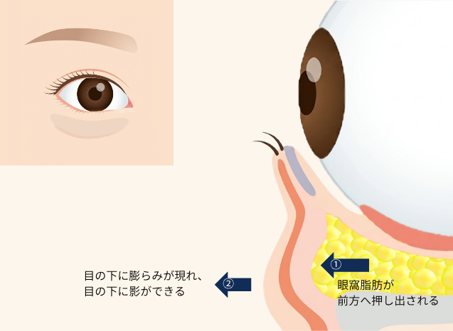 影クマ（黒クマ）のしくみ｜眼窩脂肪が前方へ押し出され、目の下に膨らみが現れて影ができる断面図