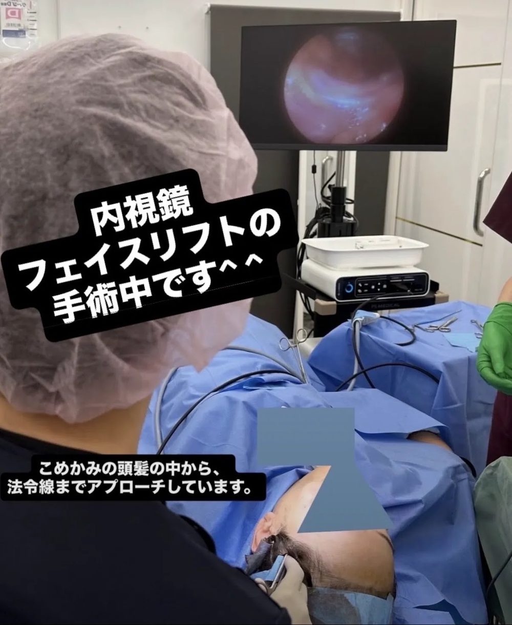 内視鏡フェイスリフトの手術風景。こめかみの頭髪内から内視鏡を挿入し、モニターの拡大視野を見ながら法令線まで剥離を進めているところ