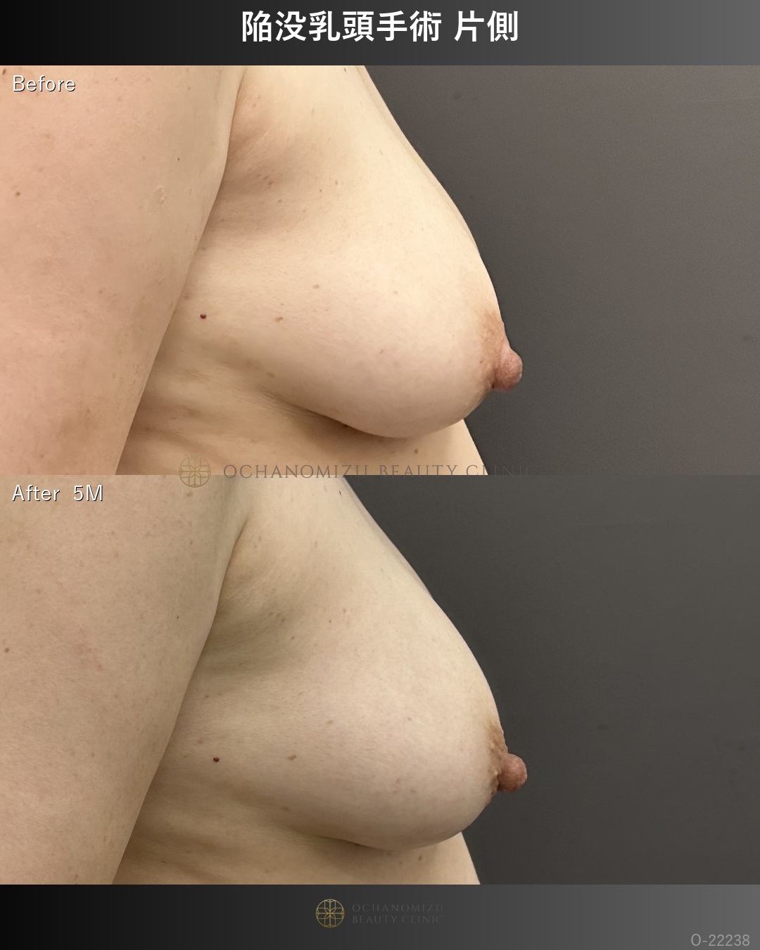陥没乳頭