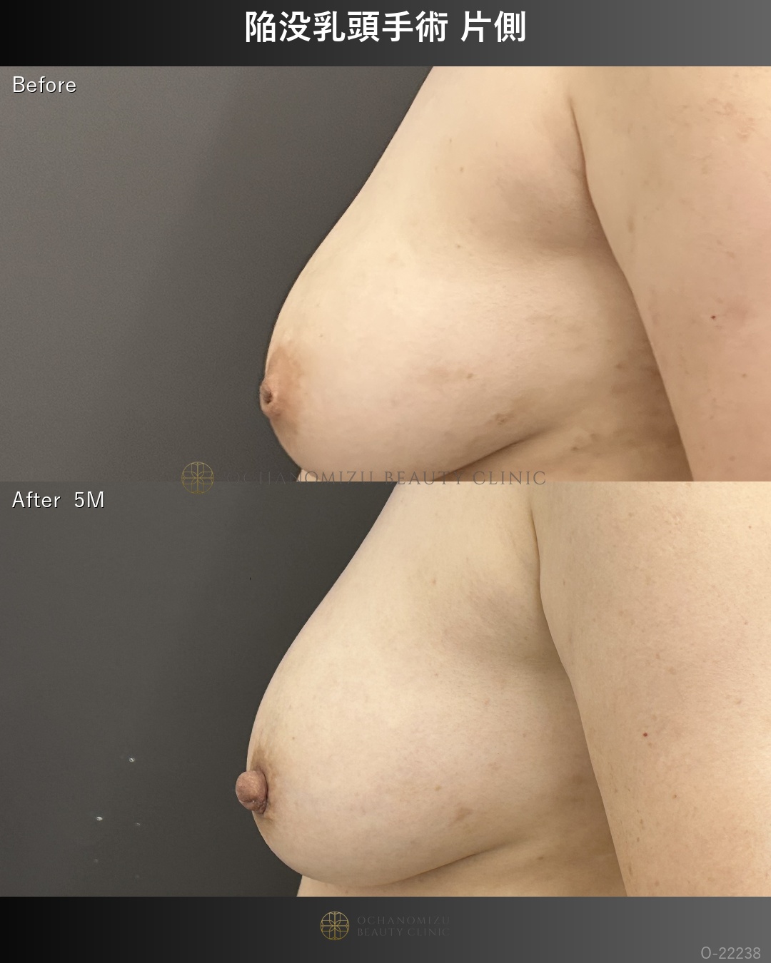 陥没乳頭