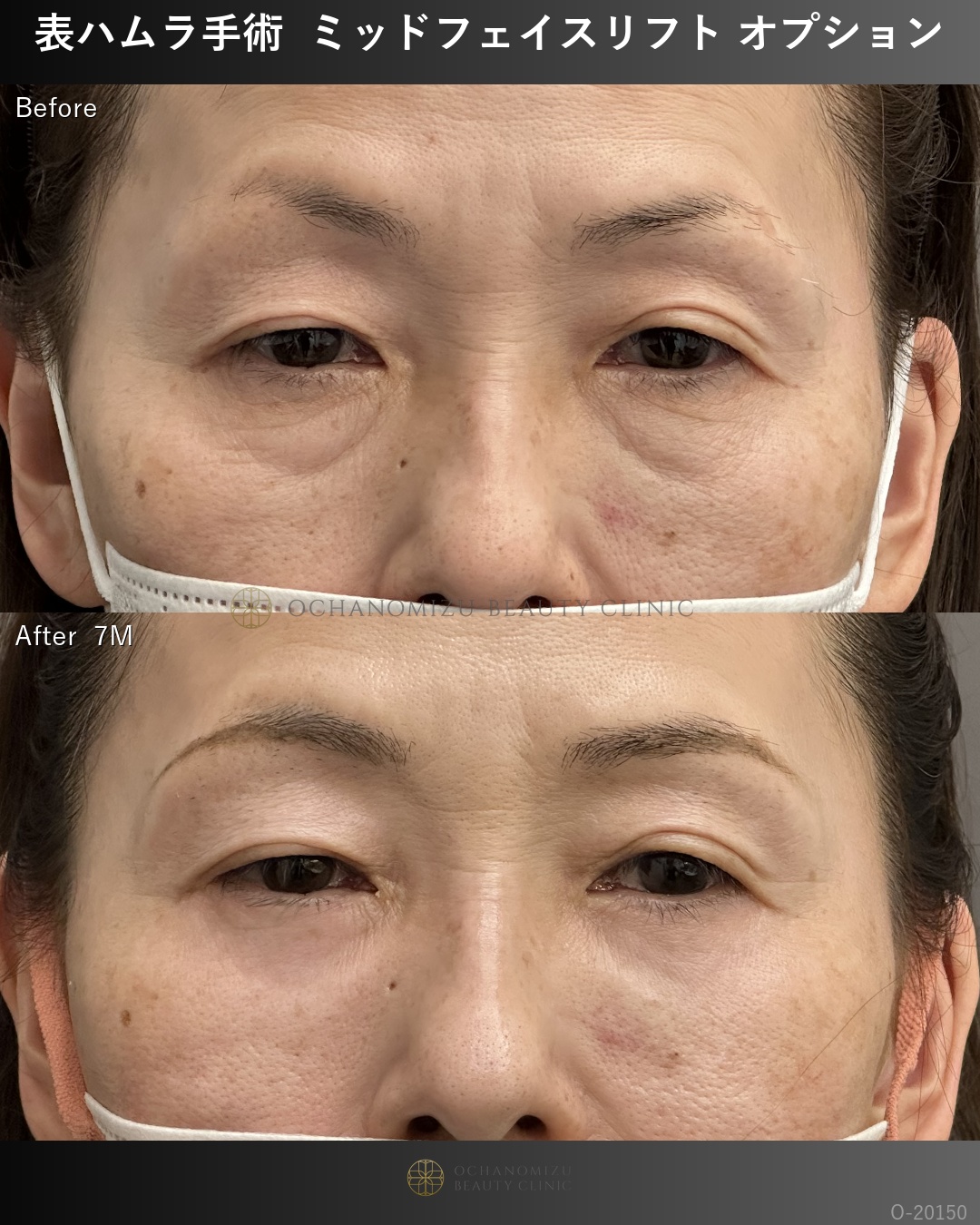 表ハムラ ミッドフェイスリフトオプション