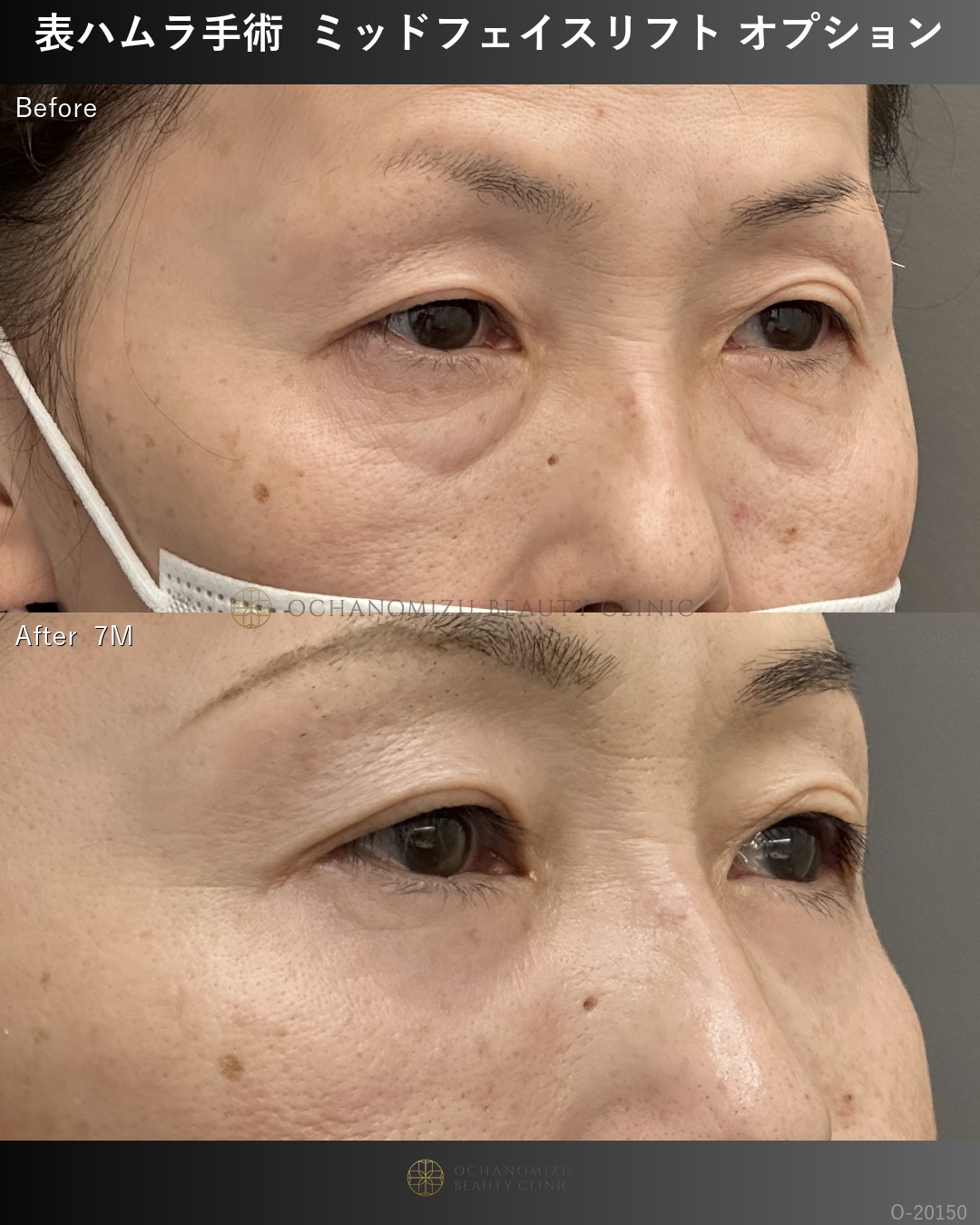 表ハムラ ミッドフェイスリフトオプション