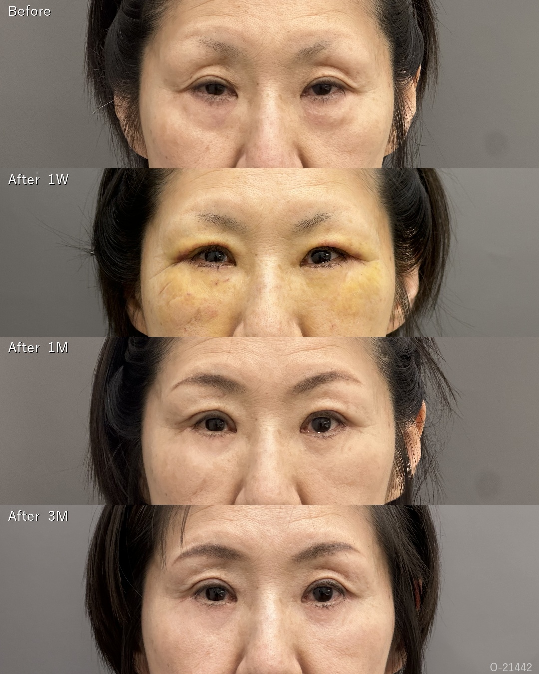眼瞼下垂術＋表ハムラ ミッドフェイスリフトオプション