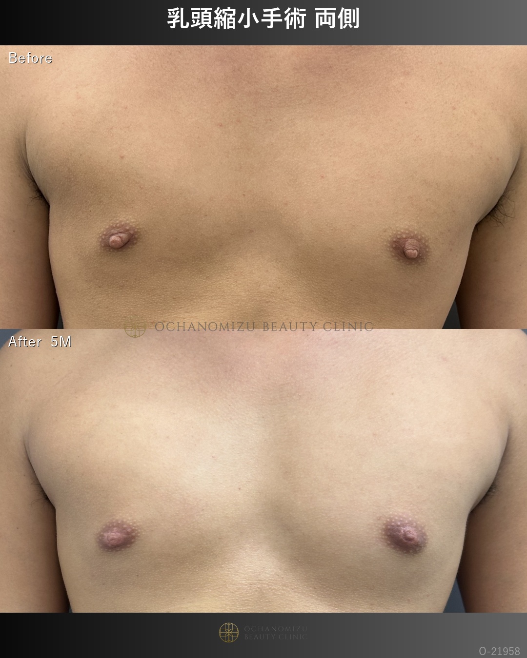 乳頭縮小