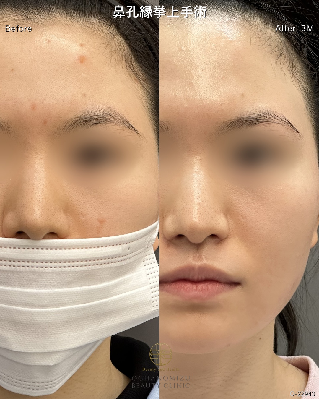 鼻孔縁挙上