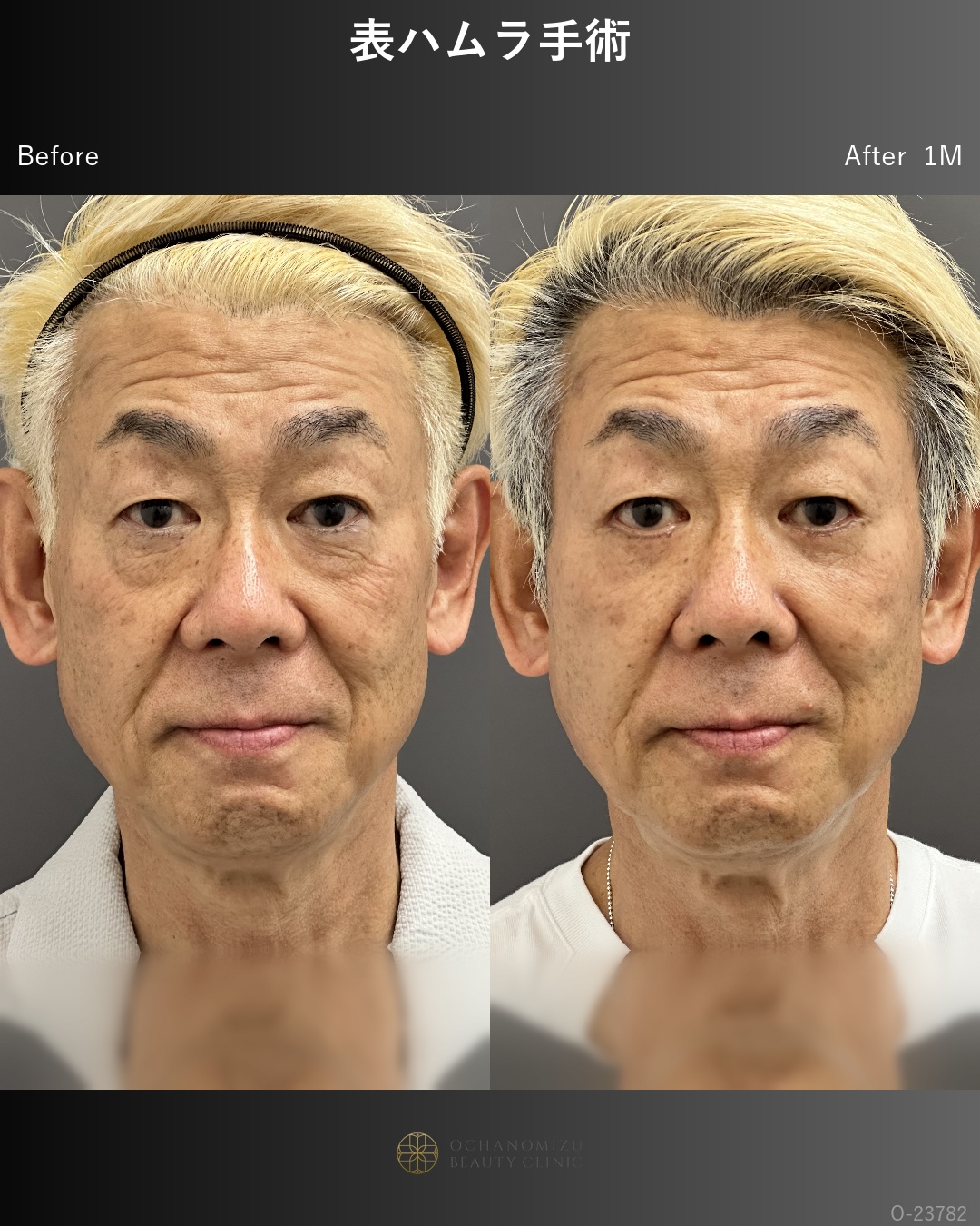 表ハムラ