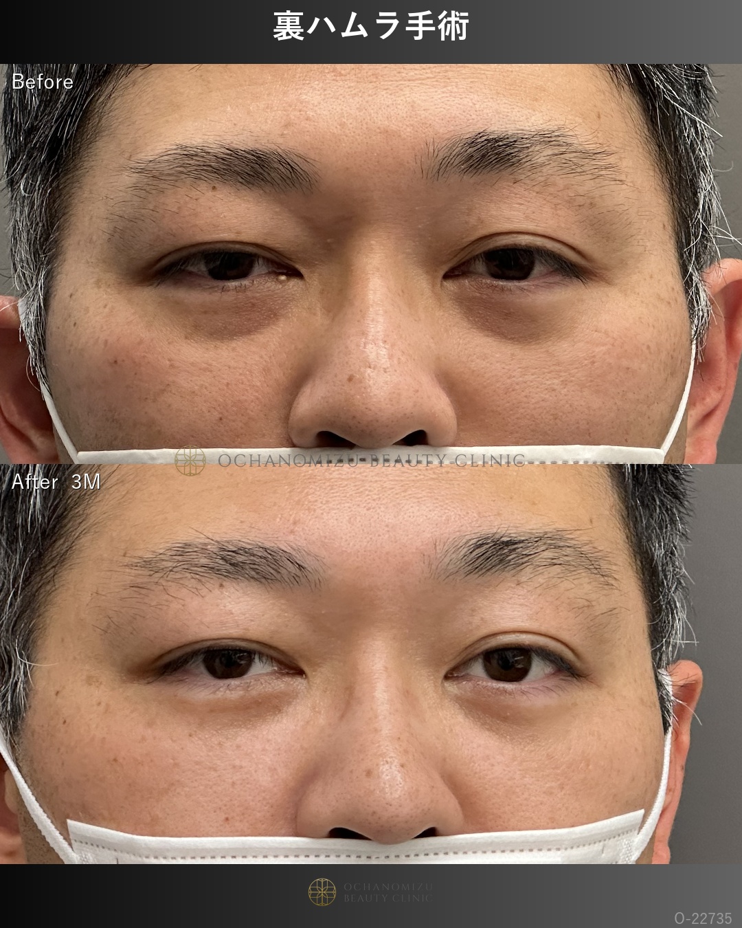 裏ハムラ