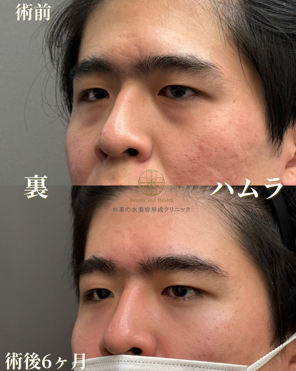裏ハムラ