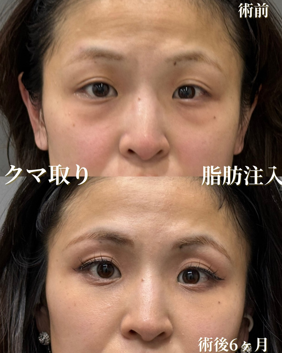 クマ取り＆脂肪注入