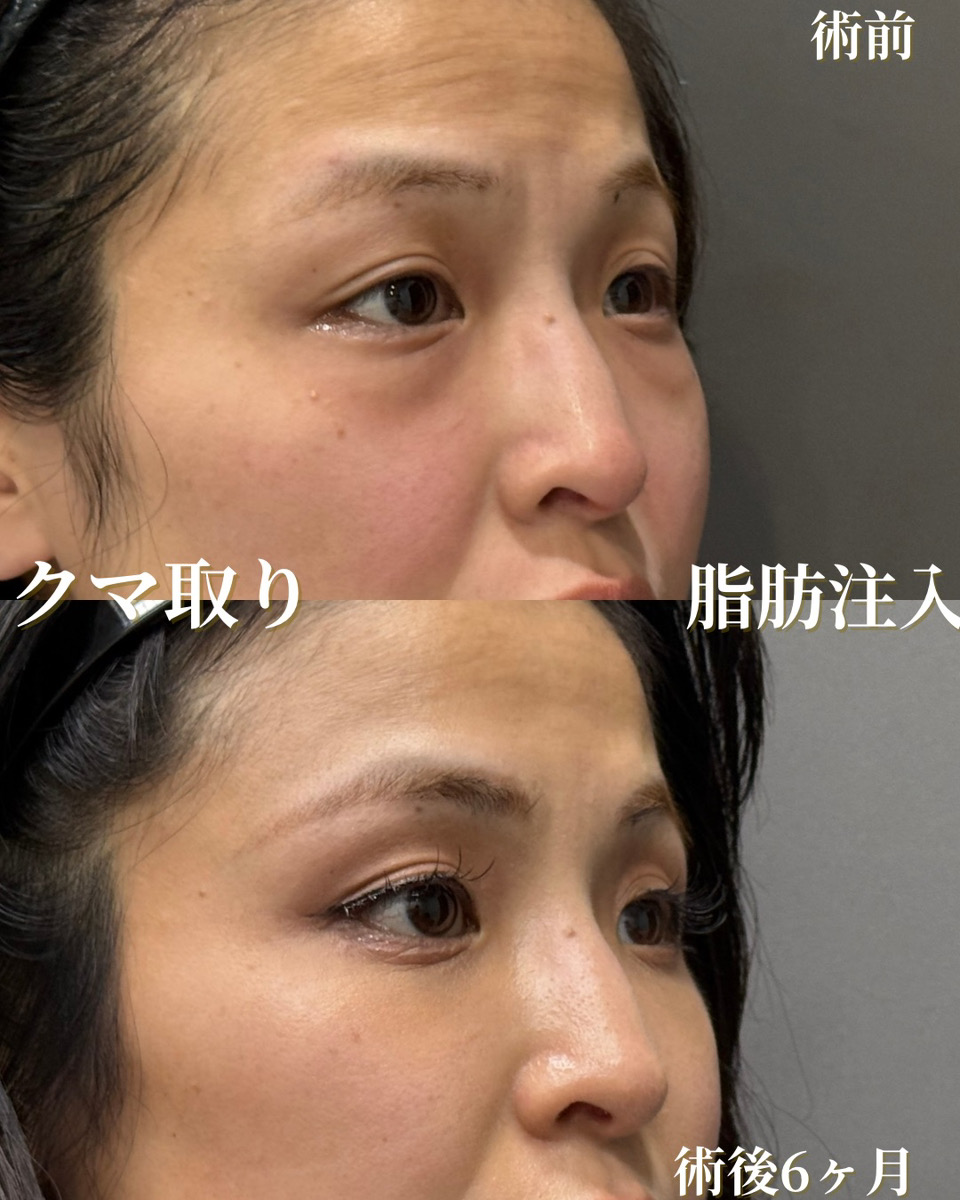 クマ取り＆脂肪注入