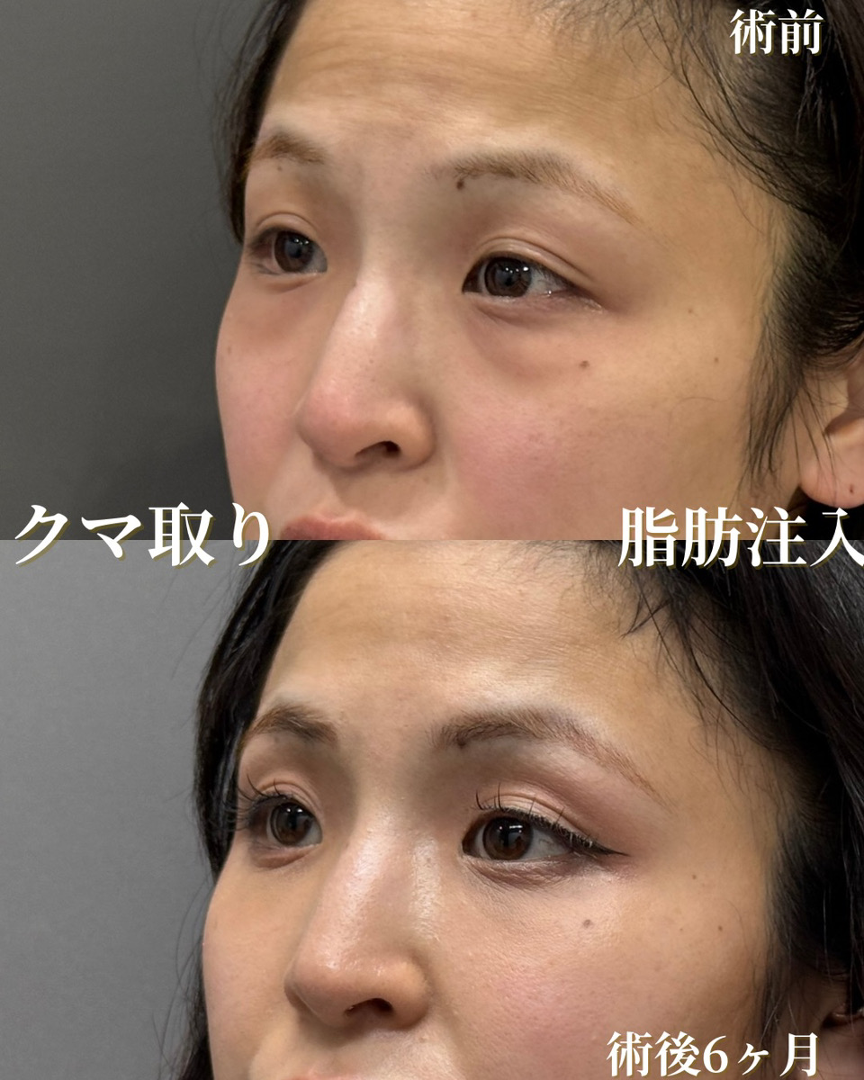 クマ取り＆脂肪注入
