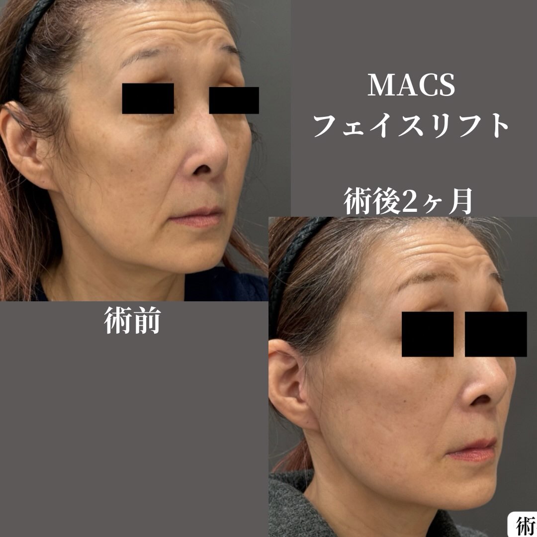 MACSフェイスリフト