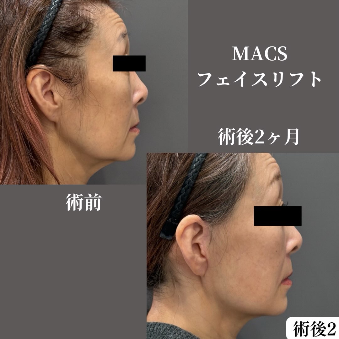 MACSフェイスリフト