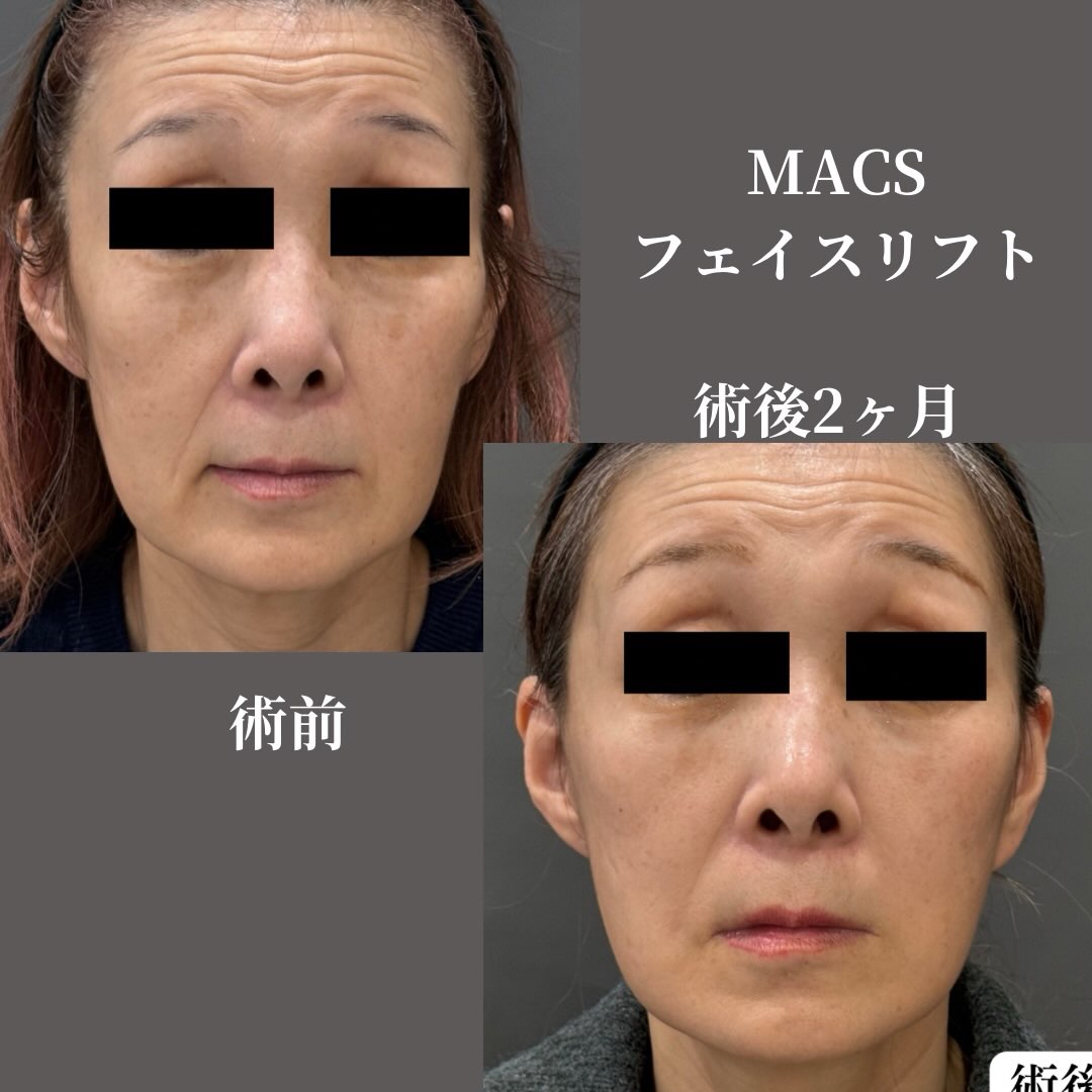 MACSフェイスリフト