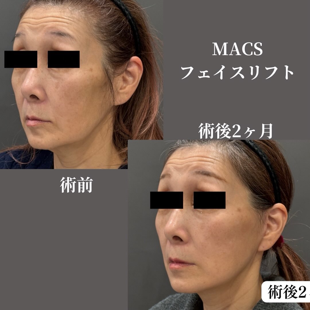 MACSフェイスリフト