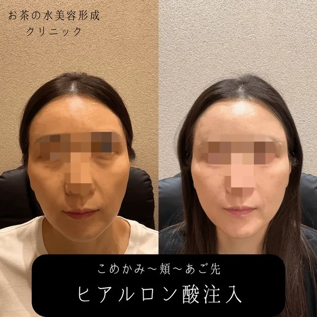 ヒアルロン酸注入（こめかみ・頬・あご）