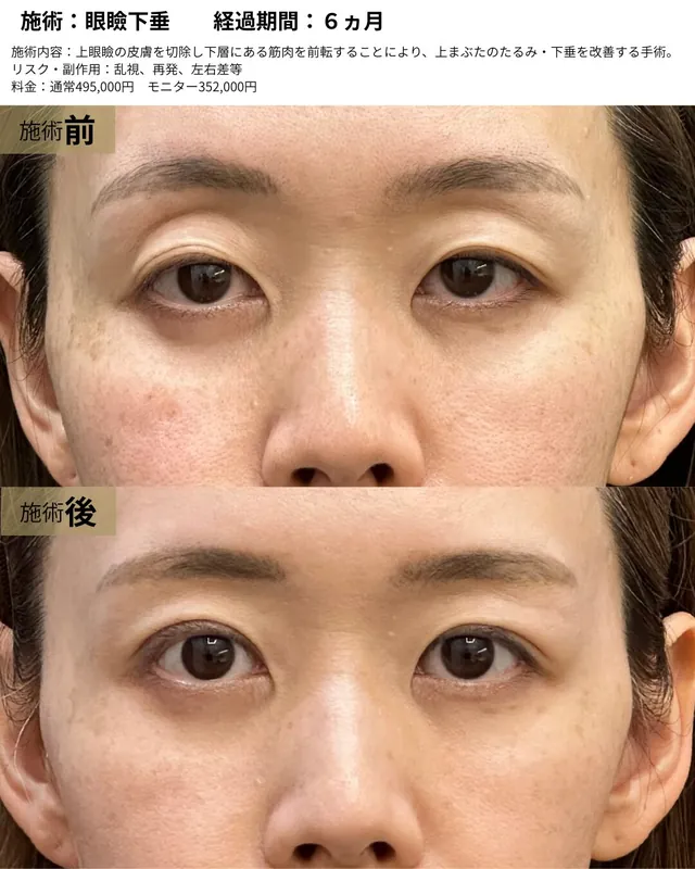 眼瞼下垂