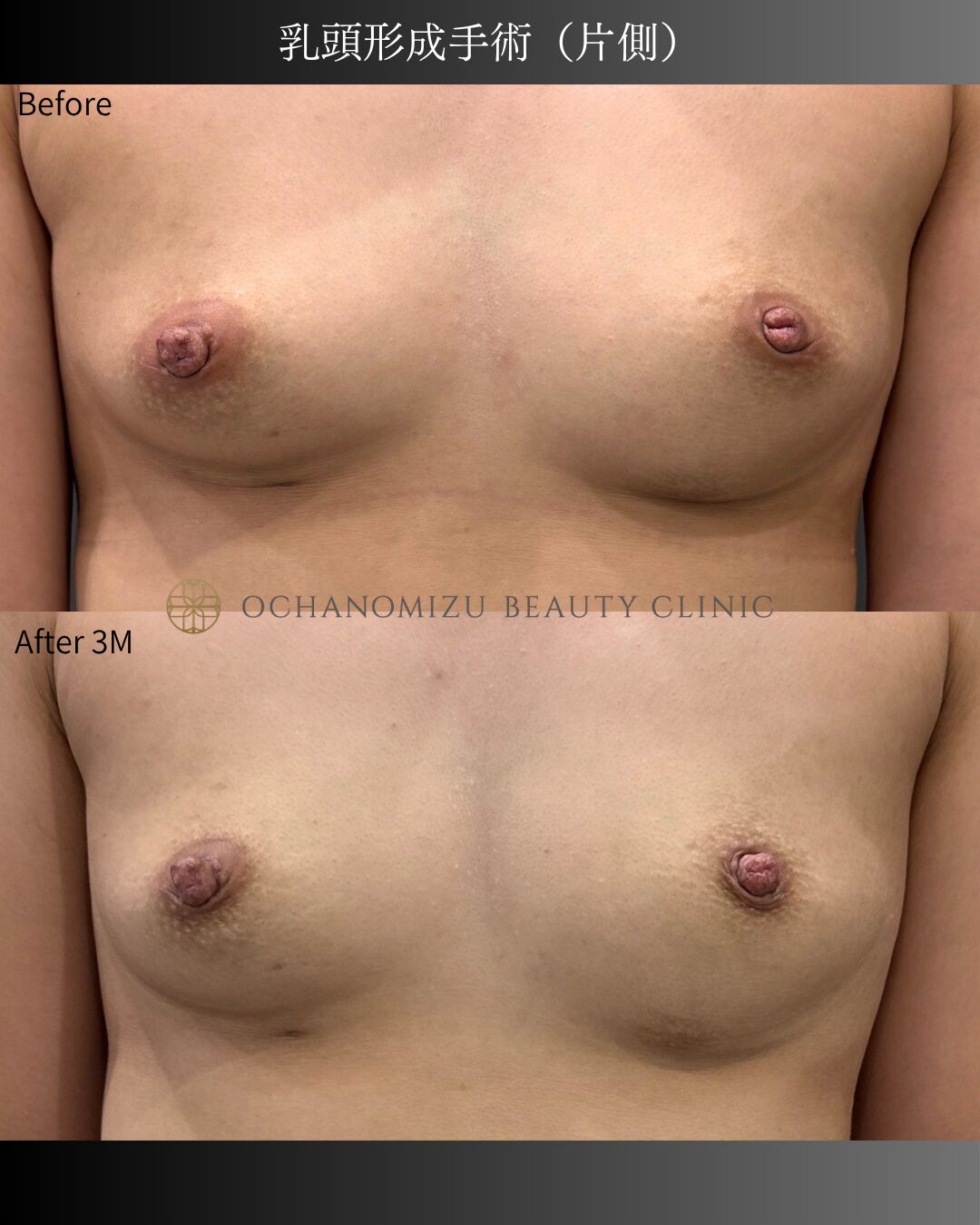 乳頭形成