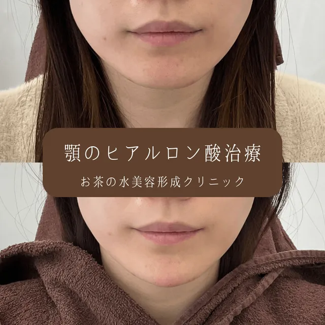 顎ヒアルロン酸注入