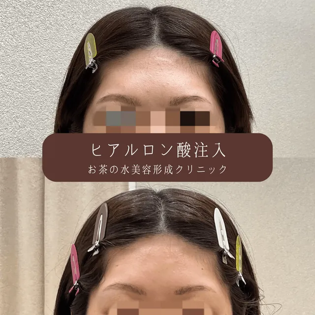 おでこヒアルロン酸注入