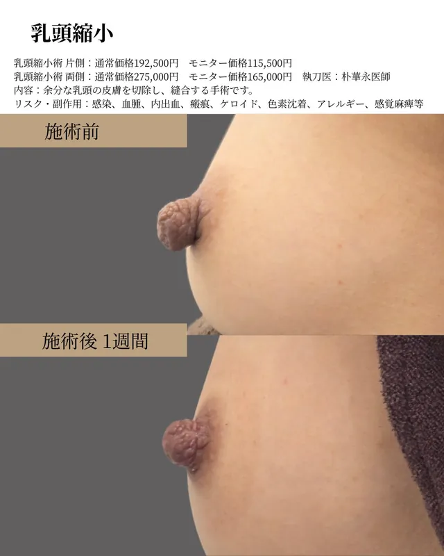乳頭縮小